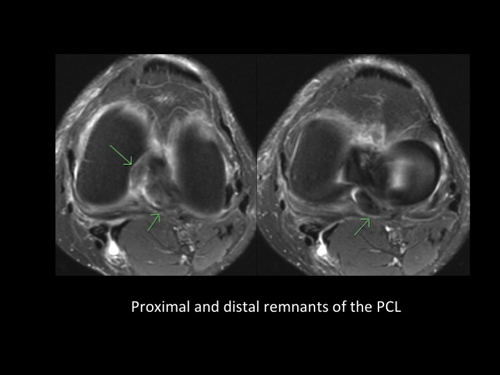 Figure 3 for case posterior cruciate ligament ( RID2784 )